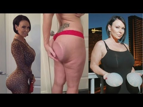 Girl’s Butt Implants Won’t Stay In Place