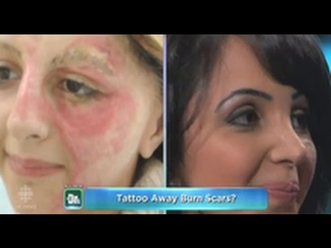 Tattoo Artist Uses Ink To Cover Burn Victims Scars