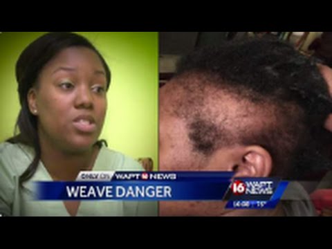 Dangers Of Hair Weave & How It Can Cause Traction Alopeca Which Causes Permanent Hair Loss